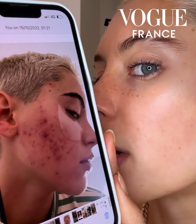 As Seen In Vogue France: Reverse Acne Scarring With Our Baby Face Laser